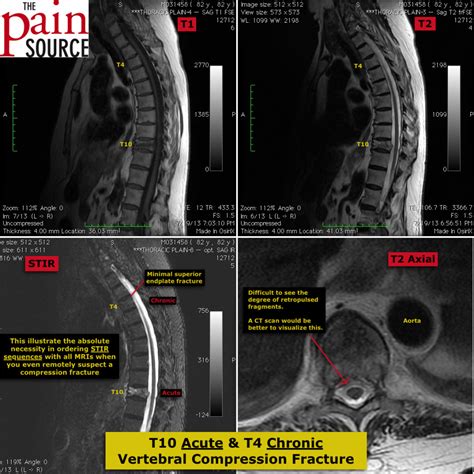 Vertebral Compression Fracture - MRI Images - The Pain Source - Makes ...