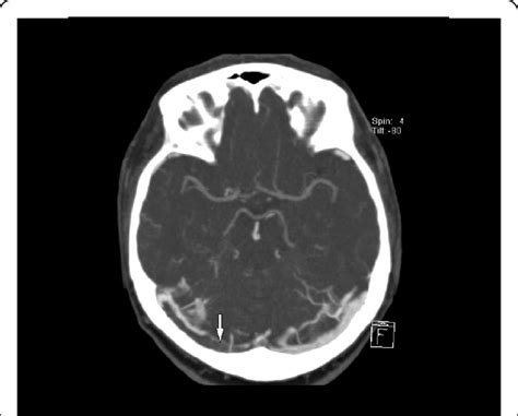 CTV showing signs of dural venous thrombosis in the right transverse ...