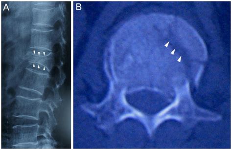 Lumbar Compression Fracture