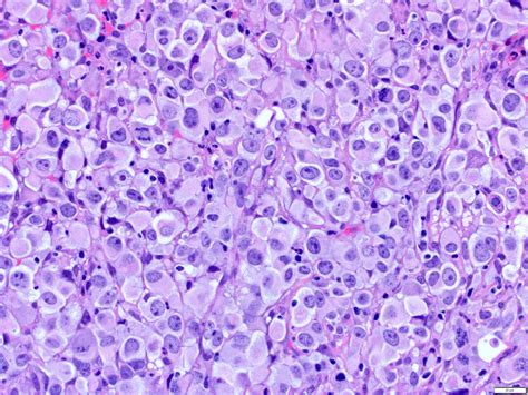 Atypical Fibroxanthoma Histology