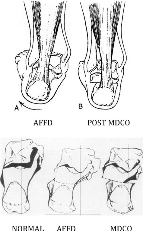 Calcaneal osteotomy in the treatment of adult acquired flatfoot ...