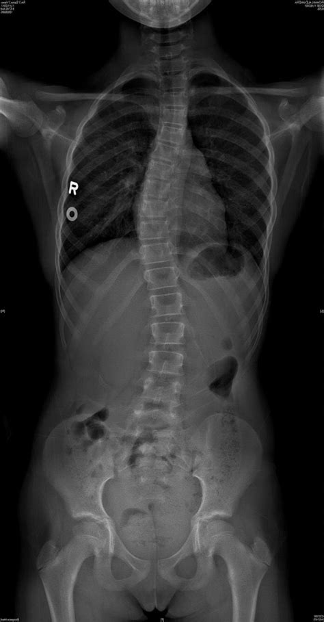 Read and Interpret X-ray and Radiologist’s Report for Scoliosis — Lyons Structural Therapy