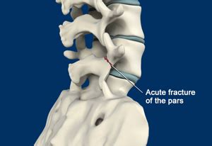 Spondylolysis Treatment New York | Spondylolysis Surgery Staten Island, NY