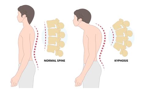 Kyphosis: Definition, Causes, Symptoms, Diagnosis, Treatment, and ...