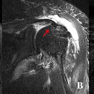 a Pre-operative MRI showed a high-grade PASTA lesion in coronal... | Download Scientific Diagram