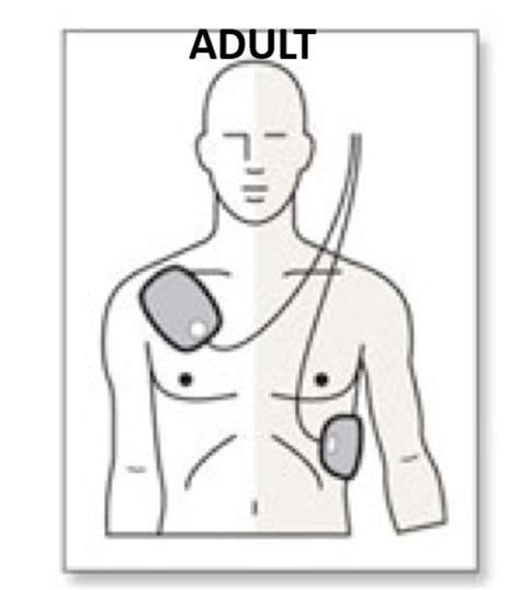 AED Pad Placement