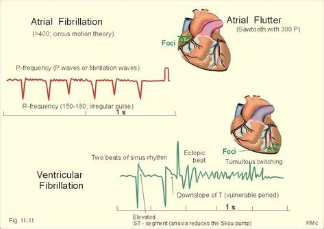 Atrial flutter treatment - mongcontrol