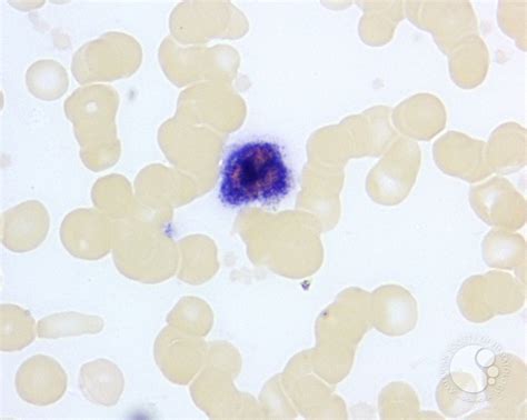 Leukocyte Alkaline Phosphatase Scoring - 4.