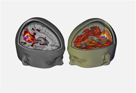 The brain on LSD revealed: first scans show how the drug affects the ...