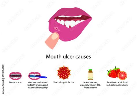 illustration of biology and medical, Aphthous ulcer, Mouth ulcer causes, Aphthous stomatitis, An ...