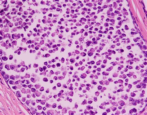 Lobular carcinoma in situ / Atypical Lobular Hyperplasia — EZ-Path