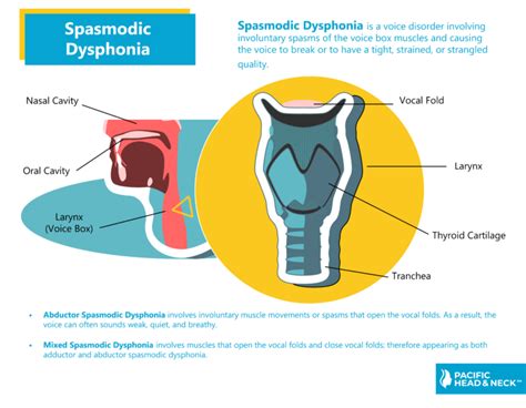 Spasmodic Dysphonia - Pacific Head & Neck