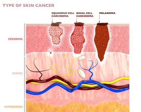 Skin Cancer Treatment | Dermatology Specialists (877) 231-3376