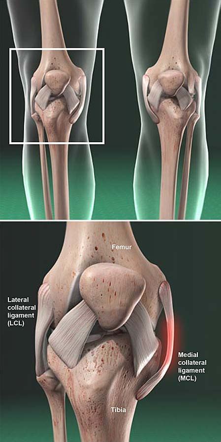 Medial Collateral Ligament (MCL) Injury | Central Coast Orthopedic Medical Group