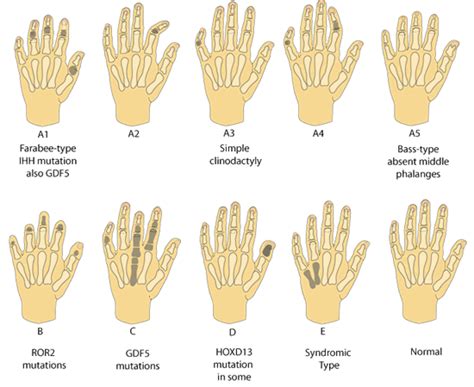 Hand Malformations » Division of Genetics and Metabolism » College of ...