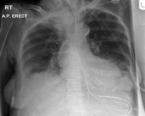 Nasogastric tubes 1: insertion technique and confirming position | Nursing Times