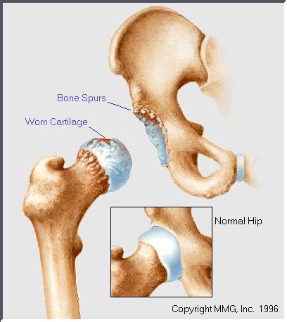 Osteoarthritis of the Hip Specialist | 🩺Singapore Sports & Orthopaedic Surgeon