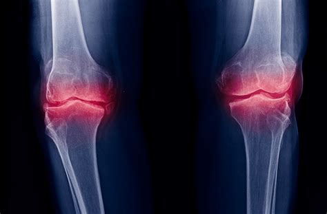 Radiographic Changes of Osteoarthritis Associated With Persistent Knee Pain - Rheumatology Advisor