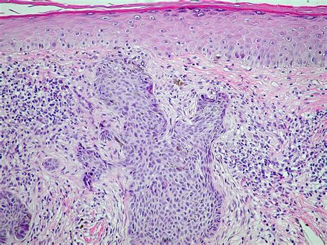 Basal Cell Carcinoma Histology