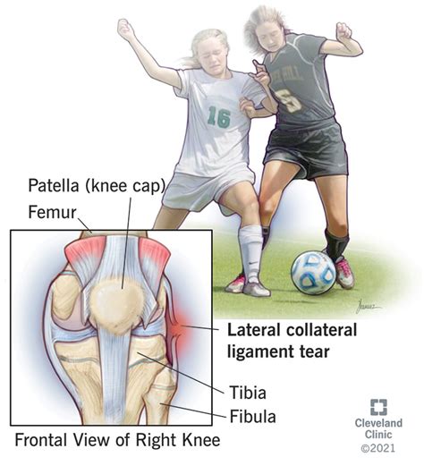 Lateral Collateral Ligament (LCL)Tear: What Is It, Causes & Treatment