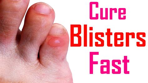 Foot Blister Remedies – Foot Care Tips