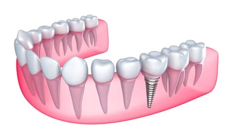 Single Tooth Implant | Your Trustworthy Oral Surgery Specialist in Huntington Beach