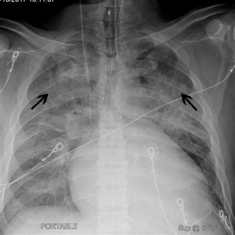 Image: Chest X-Ray of a Patient with Cardiomegaly and Cephalization - MSD Manual Professional ...