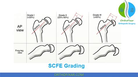 Slipped Capital Femoral Epiphysis | OrthoFixar 2024