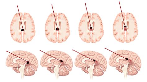 Cureus | Minimally Invasive Robotic Laser Corpus Callosotomy: A Proof of Concept