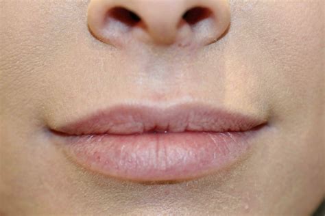 Permanent Lip liner Before and After Photos | Ruthswissa.com