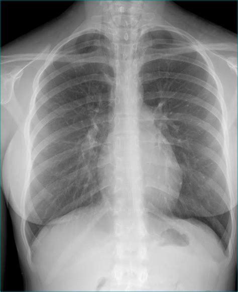 21 y/o female presents with dysphagia and pleurisy after getting into ...