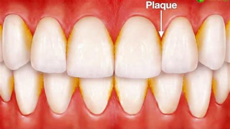 The Best Way To Remove Plaque From Teeth - Monroe Family Dentistry