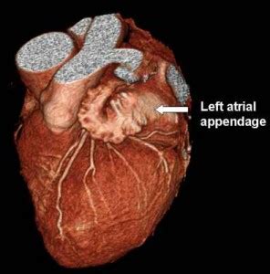 Left atrial appendage - Definition, Anatomy, Functions and Pictures