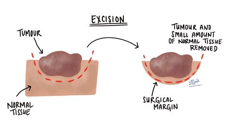 Excision | MyPathologyReport.ca