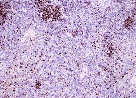 E. Immunohistochemistry staining allowed the diagnosis of a peripheral ...