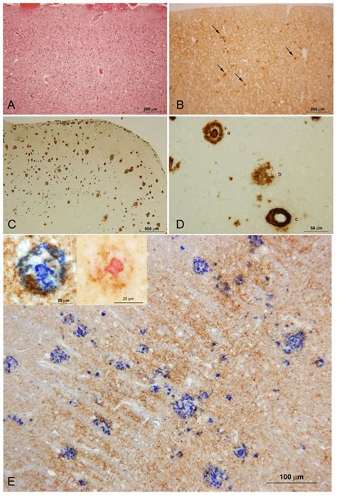 Histology and immunohistochemistry of case III-8. A: fine spongiform ...