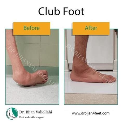 Club Foot | Dr Bijan 4 Feet