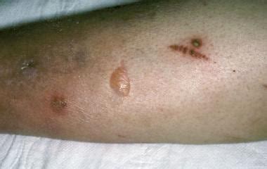 diabetic blisters pictures - pictures, photos