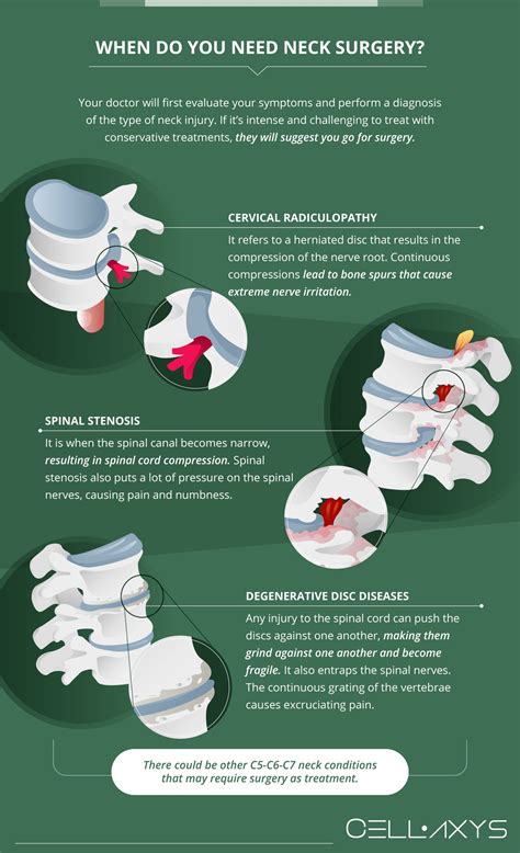 Neck Surgery C5-C6-C7 Recovery Time: What You Need To Know - Cellaxys