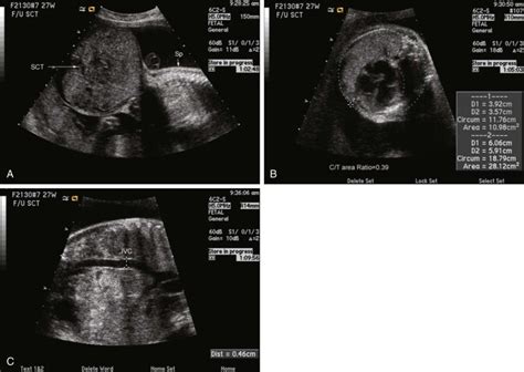 Sacrococcygeal Teratoma | Radiology Key