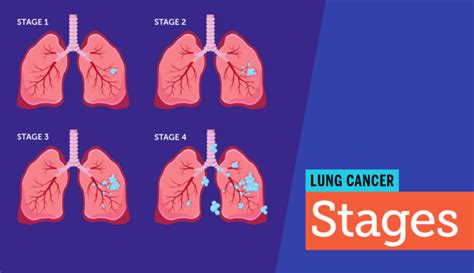 Stages Of Lung Cancer Chart