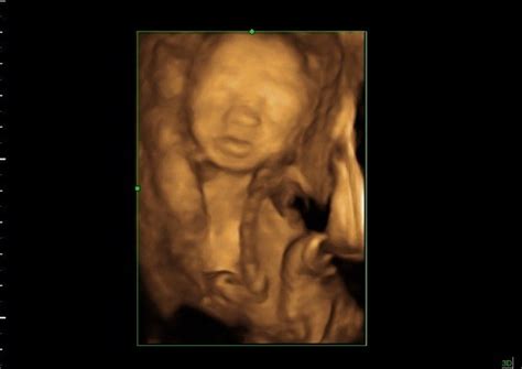 22 weeks Baby in 3D Ultrasound | 22 weeks baby image in 3D u… | Flickr