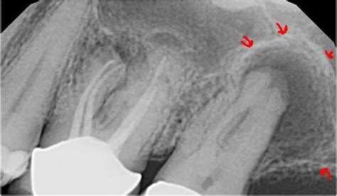 Causes of periapical granuloma - MEDizzy