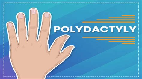 Polydactyly: Causes, Symptoms, Diagnosis And Treatment - Boldsky.com