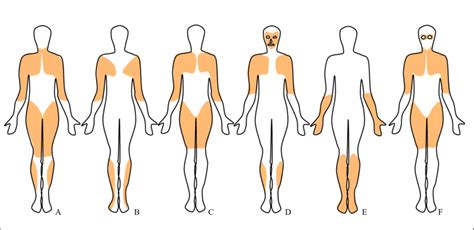 Muscular Dystrophy Types Chart