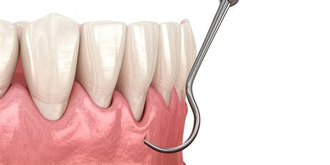 Harrisonburg PST­™ for Gum Recession - Shenandoah Valley Implant Institute