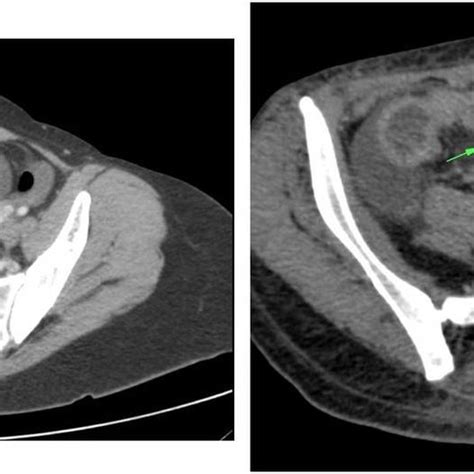 Ileocolic resection showing an edematous terminal ileum with ...