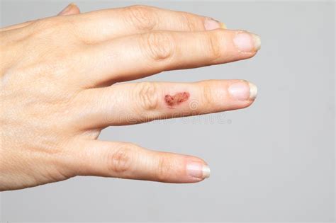 Female Hand with Impetigo, a Bacterial Infection that Causes Skin Lesions Stock Image - Image of ...