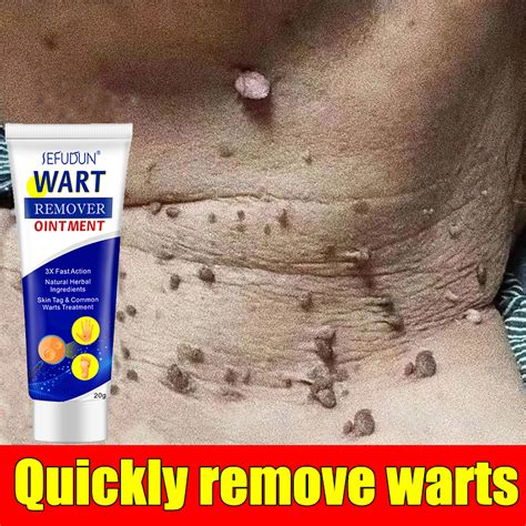 Warts Remover Original Cream Warts Magic Remover Ointment Wart Removal ...