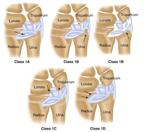 Fovea Sign Triangular Fibrocartilage Complex (TFCC) Exam, 60% OFF